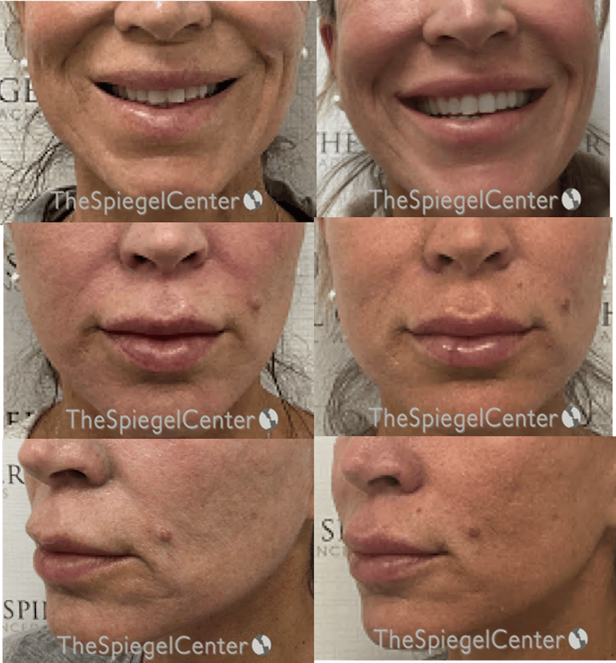 Lip Filler Before & After Gallery - Patient 369942 - Image 1