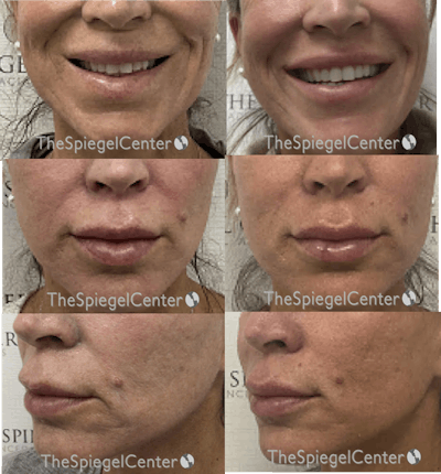 Lip Filler Before & After Gallery - Patient 369942 - Image 1