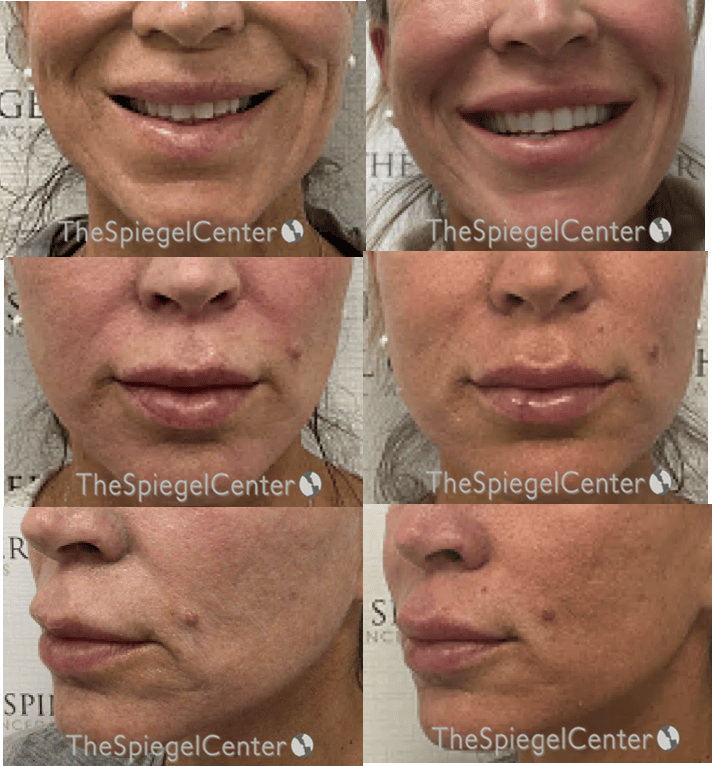Lip Filler Before & After Gallery - Patient 369942 - Image 1