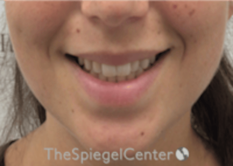 Lip Filler Before & After Gallery - Patient 318909 - Image 1