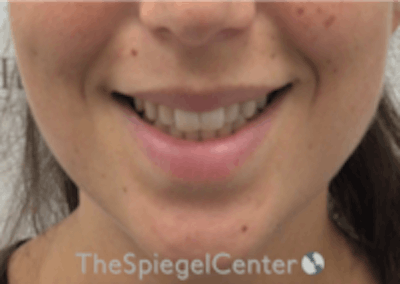 Lip Filler Before & After Gallery - Patient 318909 - Image 1
