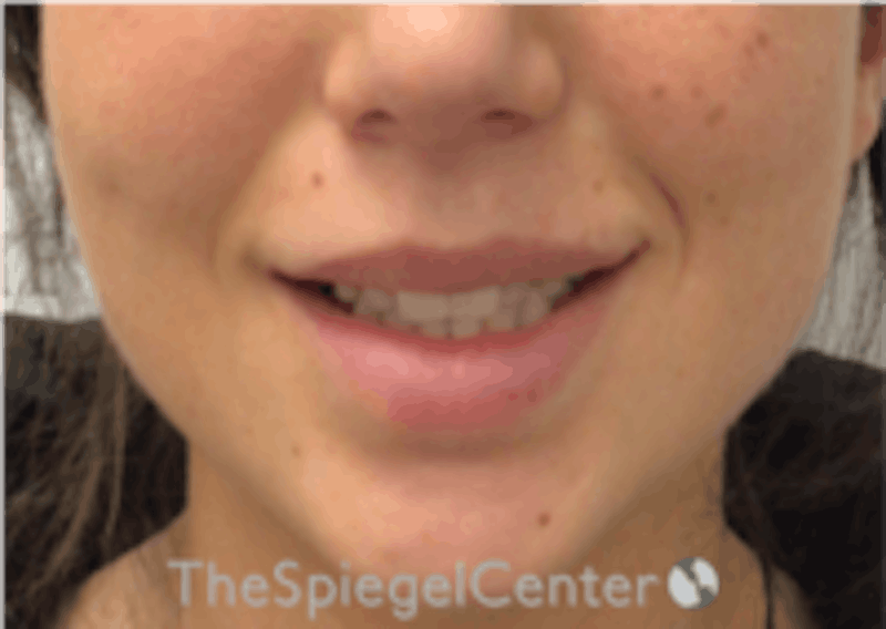 Lip Filler Before & After Gallery - Patient 318909 - Image 2