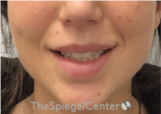 Lip Filler Before & After Gallery - Patient 318909 - Image 2