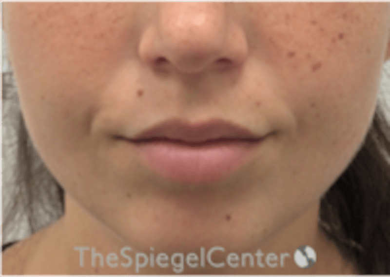 Lip Filler Before & After Gallery - Patient 318909 - Image 3