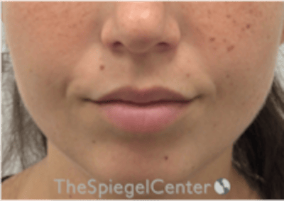 Lip Filler Before & After Gallery - Patient 318909 - Image 3
