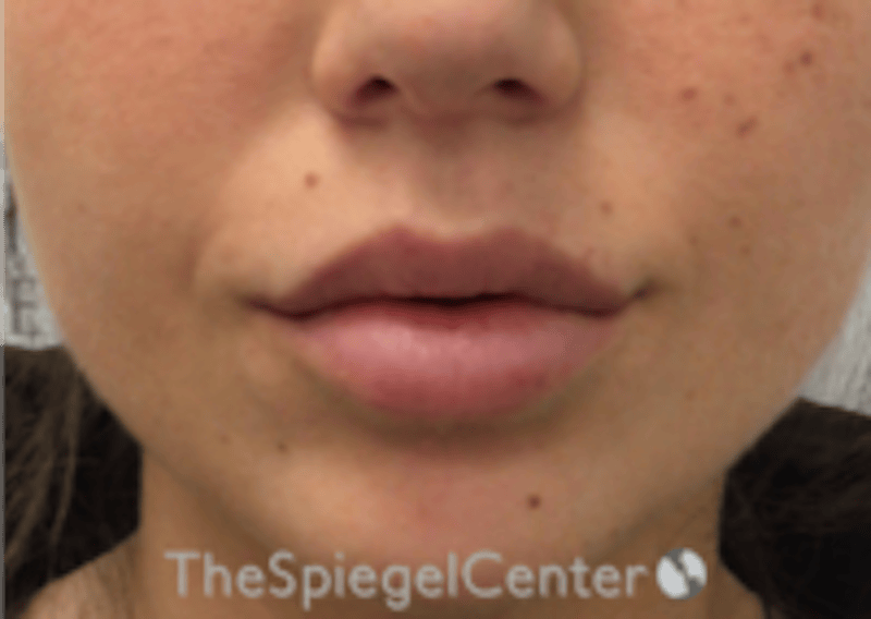 Lip Filler Before & After Gallery - Patient 318909 - Image 4