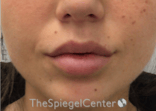 Lip Filler Before & After Gallery - Patient 318909 - Image 4