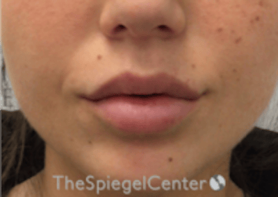 Lip Filler Before & After Gallery - Patient 318909 - Image 4