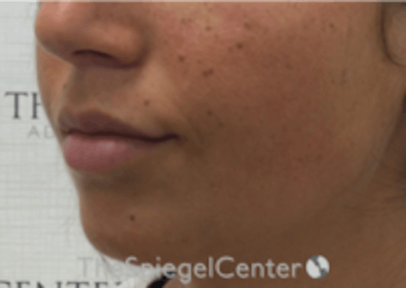 Lip Filler Before & After Gallery - Patient 318909 - Image 5