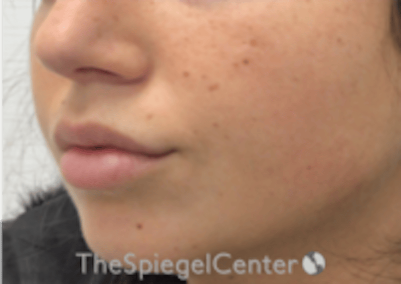 Lip Filler Before & After Gallery - Patient 318909 - Image 6