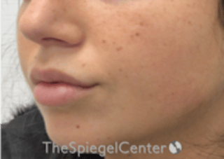 Lip Filler Before & After Gallery - Patient 318909 - Image 6