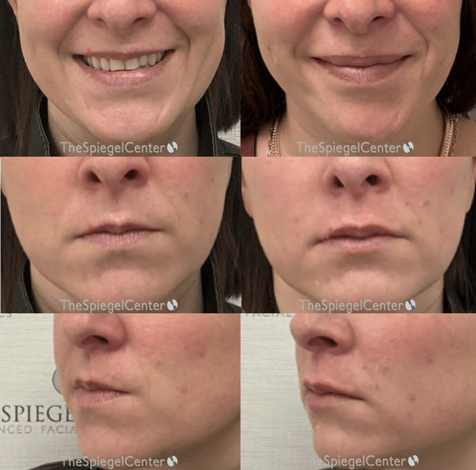 Lip Filler Before & After Gallery - Patient 184906 - Image 1