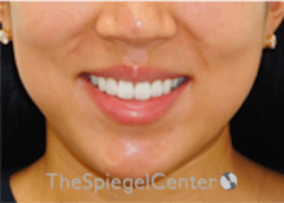 Lip Filler Before & After Gallery - Patient 277655 - Image 1