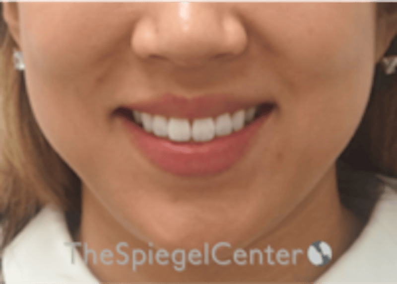 Lip Filler Before & After Gallery - Patient 277655 - Image 2