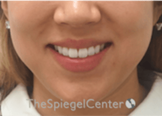 Lip Filler Before & After Gallery - Patient 277655 - Image 2