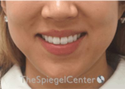 Lip Filler Before & After Gallery - Patient 277655 - Image 2