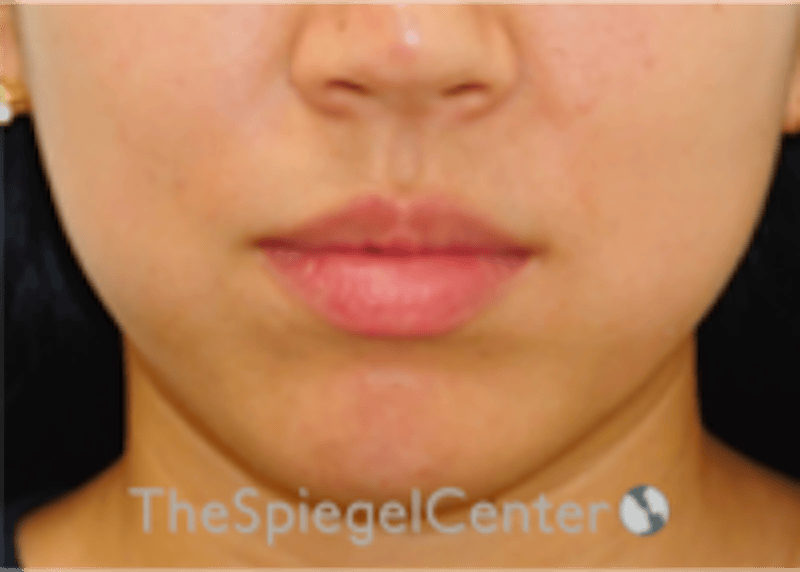 Lip Filler Before & After Gallery - Patient 277655 - Image 3