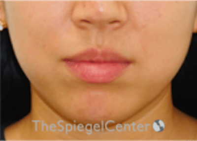 Lip Filler Before & After Gallery - Patient 277655 - Image 3