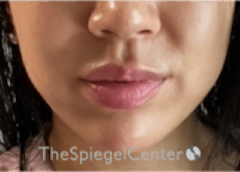Lip Filler Before & After Gallery - Patient 277655 - Image 4