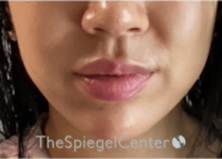 Lip Filler Before & After Gallery - Patient 277655 - Image 4