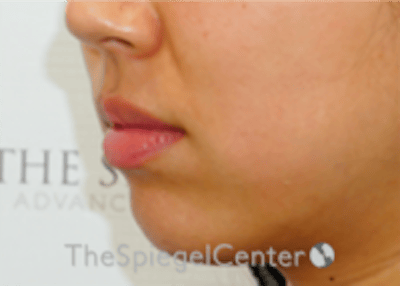 Lip Filler Before & After Gallery - Patient 277655 - Image 5