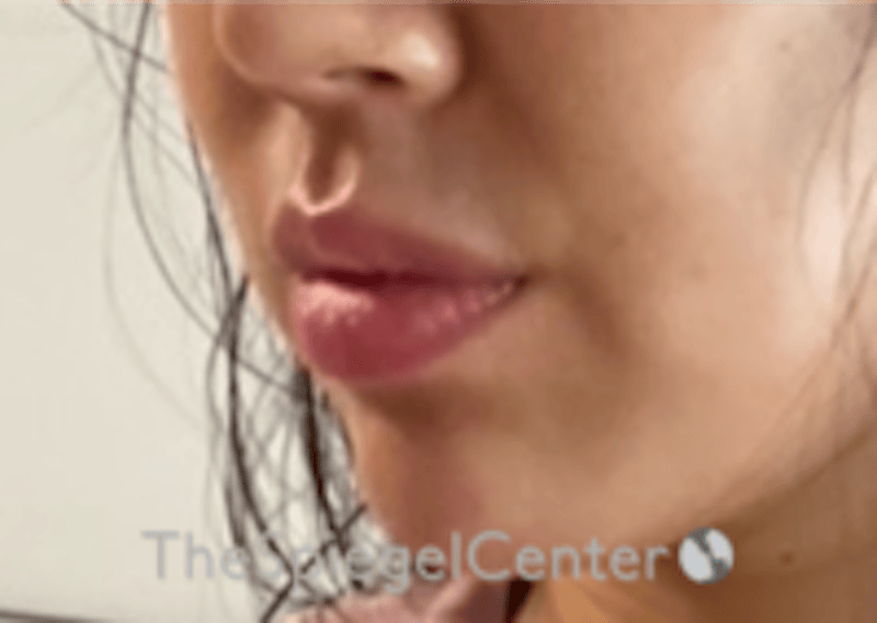 Lip Filler Before & After Gallery - Patient 277655 - Image 6