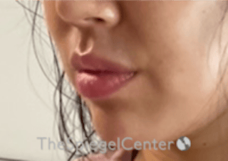 Lip Filler Before & After Gallery - Patient 277655 - Image 6