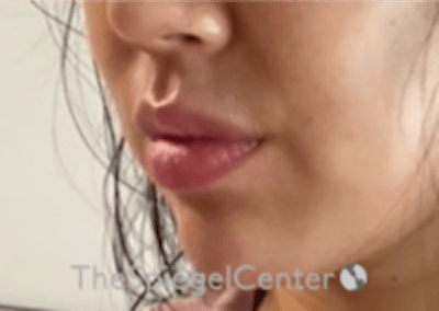 Lip Filler Before & After Gallery - Patient 277655 - Image 6