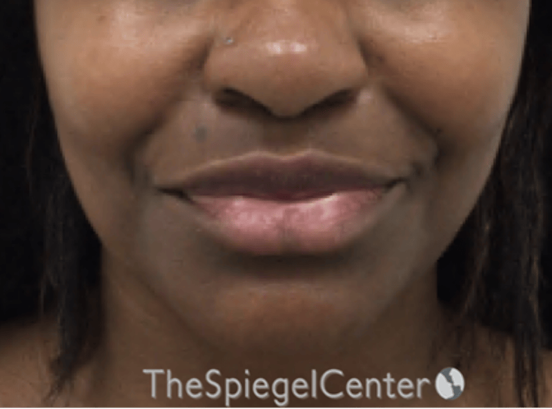 Lip Filler Before & After Gallery - Patient 121012 - Image 1