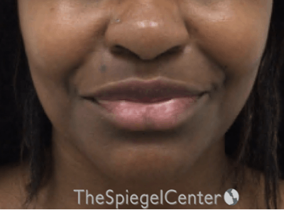 Lip Filler Before & After Gallery - Patient 121012 - Image 1