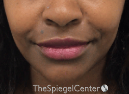 Lip Filler Before & After Gallery - Patient 121012 - Image 2