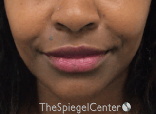 Lip Filler Before & After Gallery - Patient 121012 - Image 2