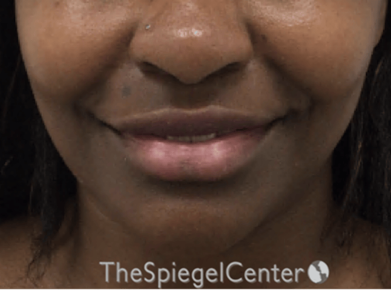 Lip Filler Before & After Gallery - Patient 121012 - Image 3
