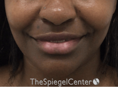 Lip Filler Before & After Gallery - Patient 121012 - Image 3
