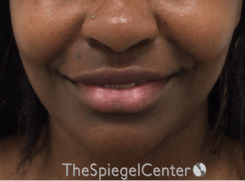 Lip Filler Before & After Gallery - Patient 121012 - Image 3