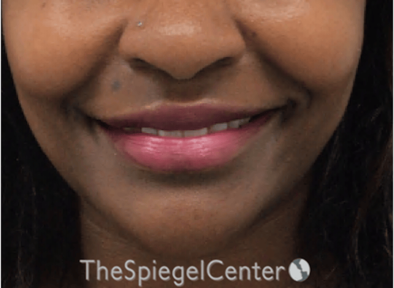 Lip Filler Before & After Gallery - Patient 121012 - Image 4