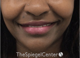 Lip Filler Before & After Gallery - Patient 121012 - Image 4