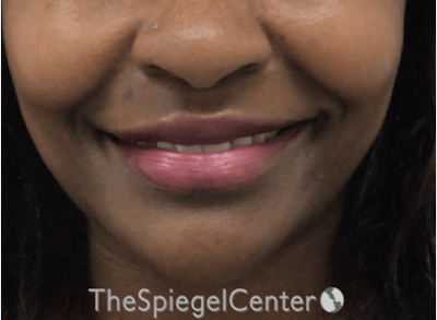 Lip Filler Before & After Gallery - Patient 121012 - Image 4
