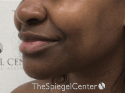 Lip Filler Before & After Gallery - Patient 121012 - Image 5