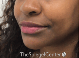 Lip Filler Before & After Gallery - Patient 121012 - Image 6