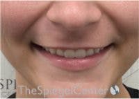 Lip Filler Before & After Gallery - Patient 379604 - Image 1