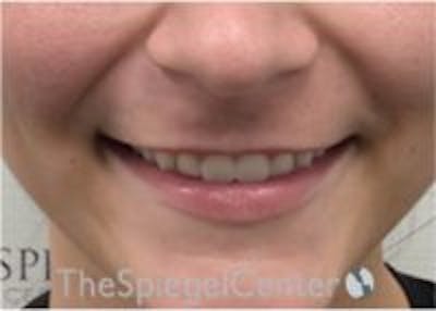 Lip Filler Before & After Gallery - Patient 379604 - Image 1