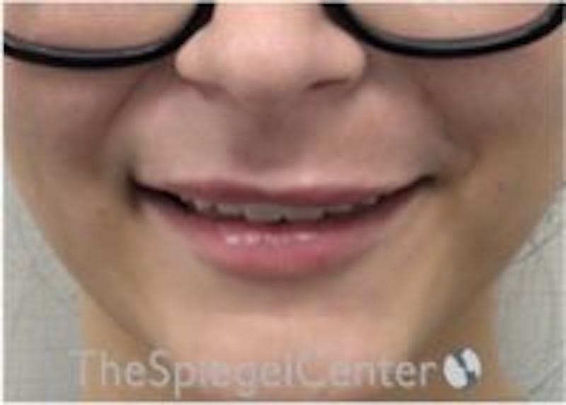 Lip Filler Before & After Gallery - Patient 379604 - Image 2