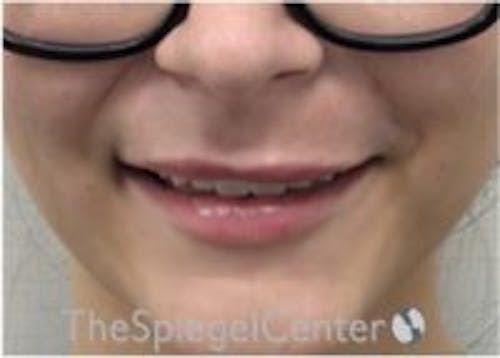 Lip Filler Before & After Gallery - Patient 379604 - Image 2