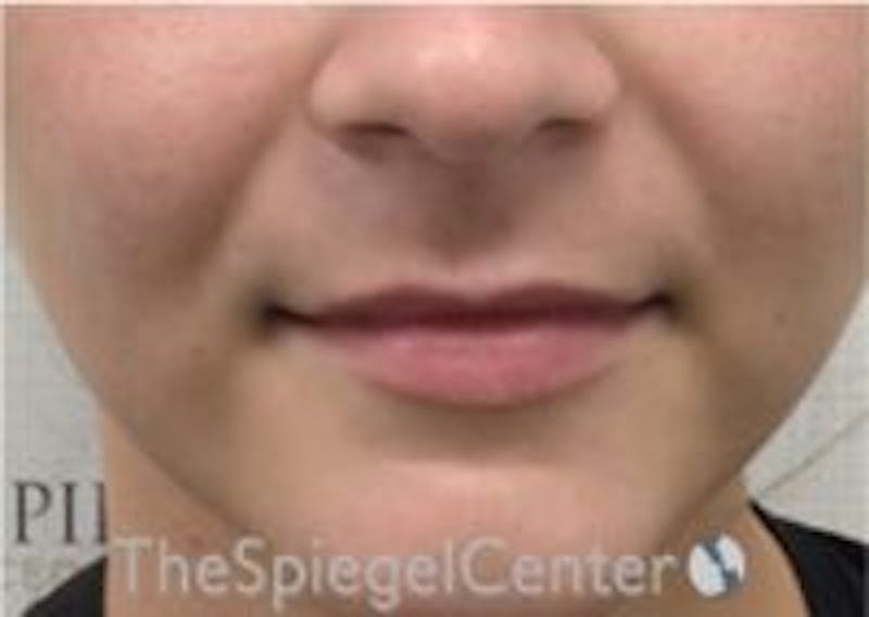 Lip Filler Before & After Gallery - Patient 379604 - Image 3
