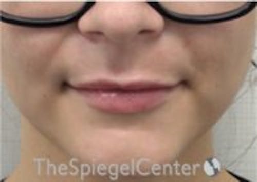 Lip Filler Before & After Gallery - Patient 379604 - Image 4