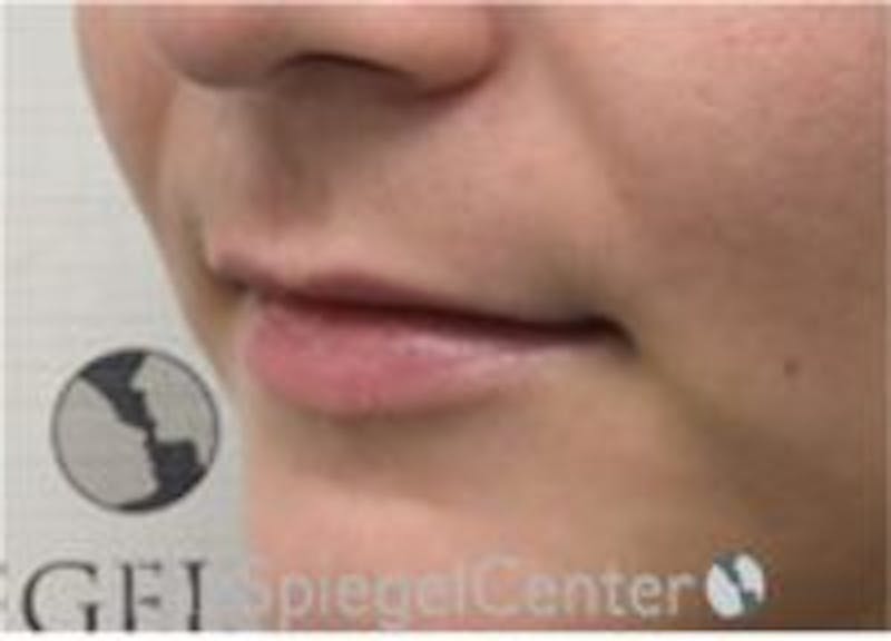 Lip Filler Before & After Gallery - Patient 379604 - Image 5