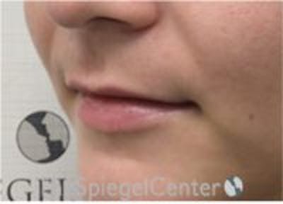Lip Filler Before & After Gallery - Patient 379604 - Image 5