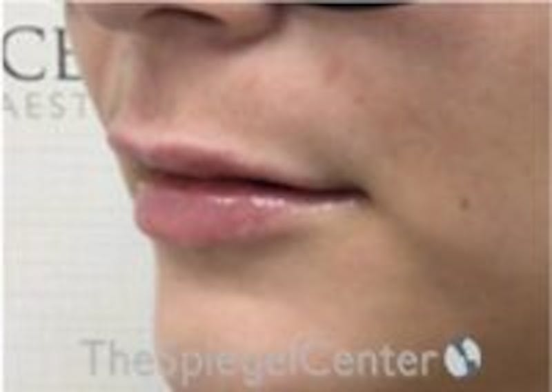 Lip Filler Before & After Gallery - Patient 379604 - Image 6