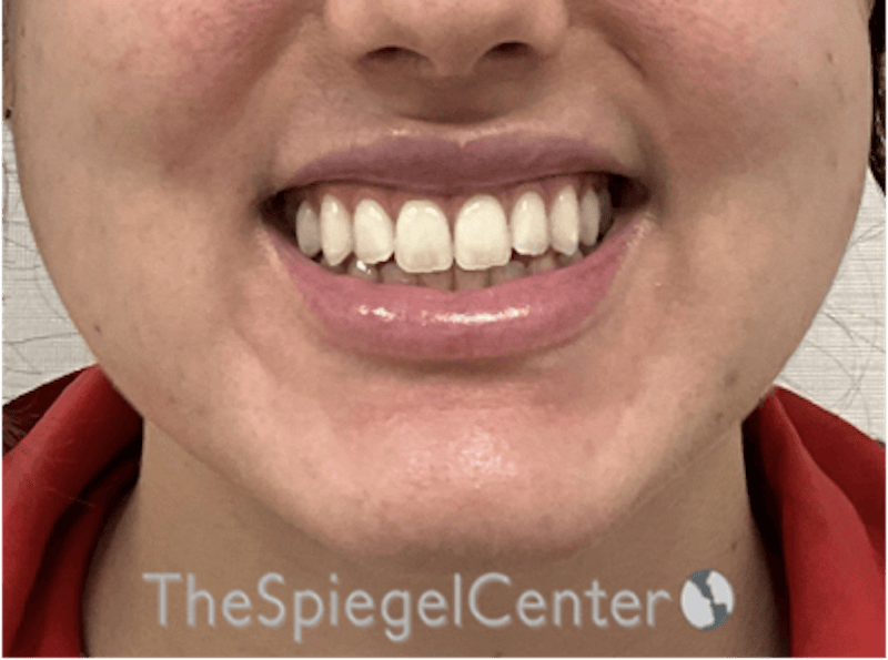 Lip Filler Before & After Gallery - Patient 337305 - Image 1